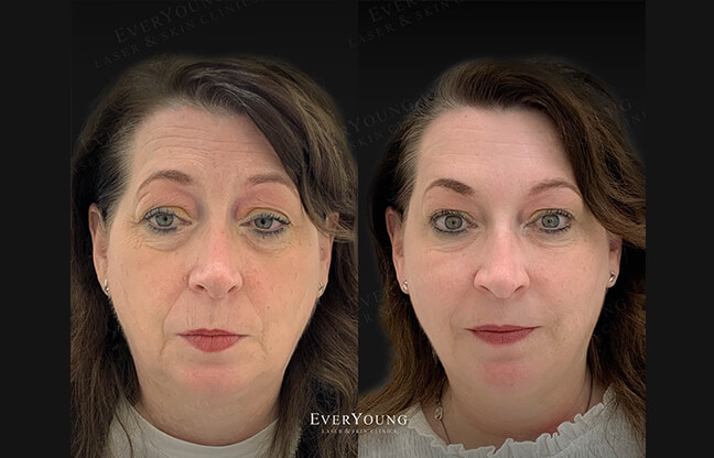 Brow Lift - Before & After Treatment | EverYoung Skin Clinic Vancouver