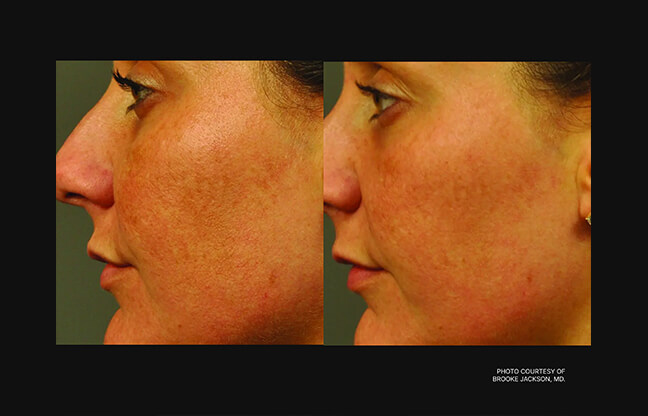Clear + Brilliant Laser Skin Treatment - Before & After 1 | EverYoung Skin Clinic