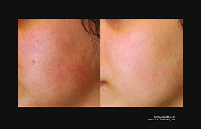 Clear + Brilliant Laser Skin Treatment - Before & After 2 | EverYoung Skin Clinic