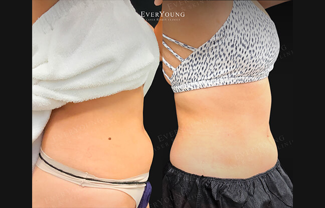 CoolSculpting & Fat Freezing - Before & After 2 | EverYoung Skin Clinic