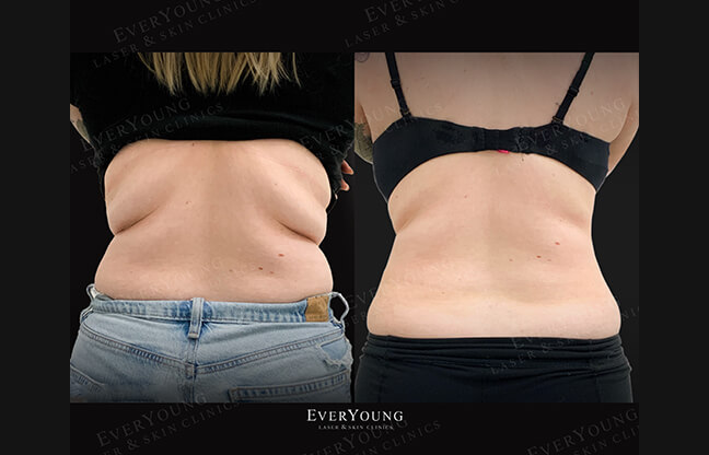 CoolSculpting & Fat Freezing - Before & After 2 | EverYoung Skin Clinic