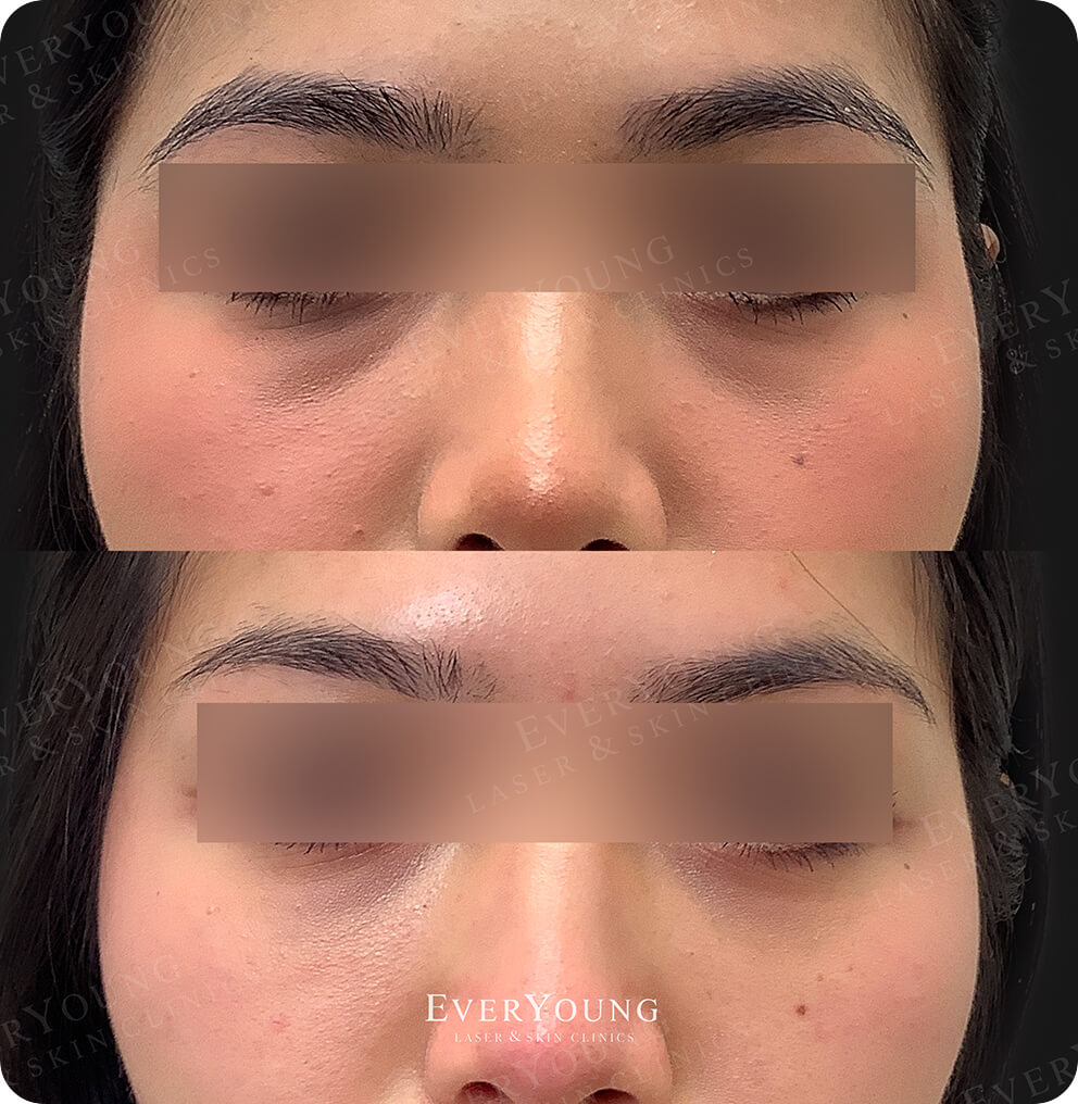 Dermal Fillers - Before & After | EverYoung Skin Clinic Vancouver