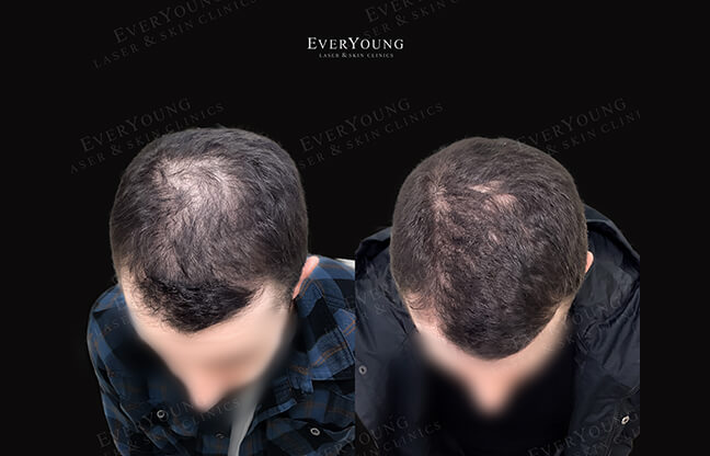 PRP Hair Loss - Before & After Treatment | EverYoung Skin Clinic
