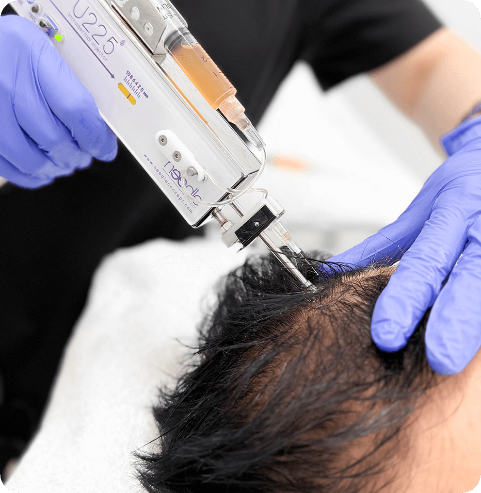 prp-hair-treatment PRP Hair Treatment in Vancouver | EverYoung Skin Clinic