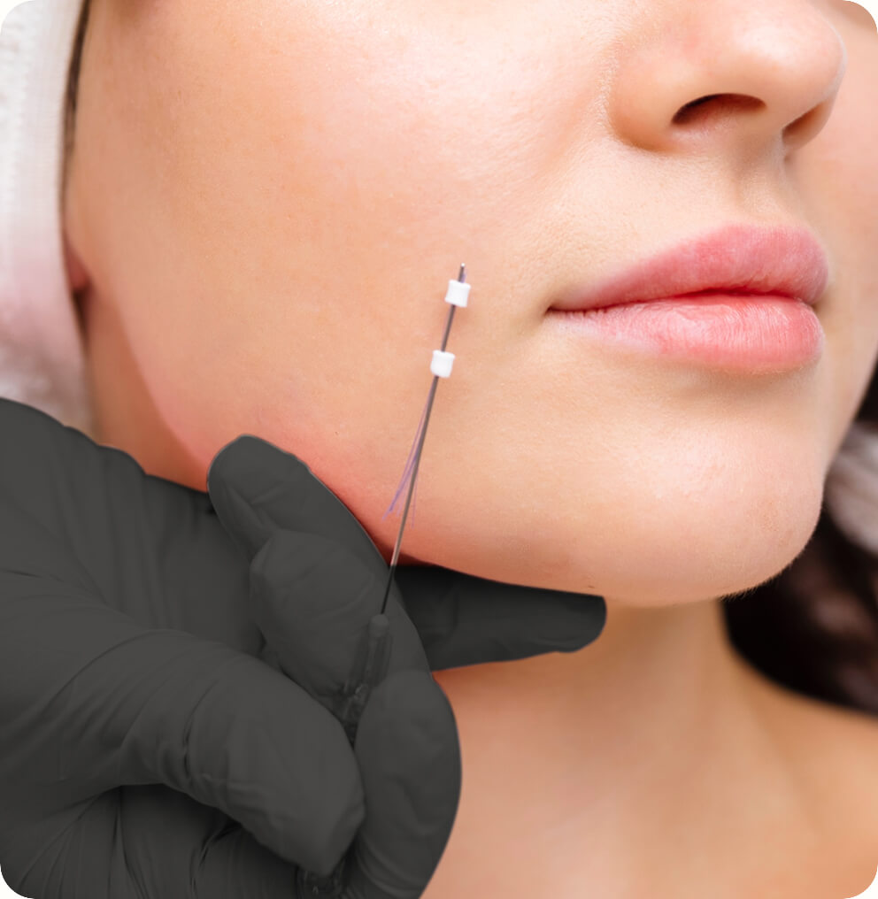 Thread Lift Vancouver | EverYoung Skin Clinic