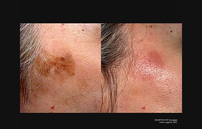 Fotona StarWalker® - Before & After 1 | EverYoung Skin Clinic
