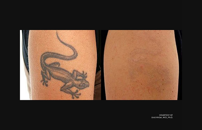 Fotona StarWalker® - Before & After 2 | EverYoung Skin Clinic