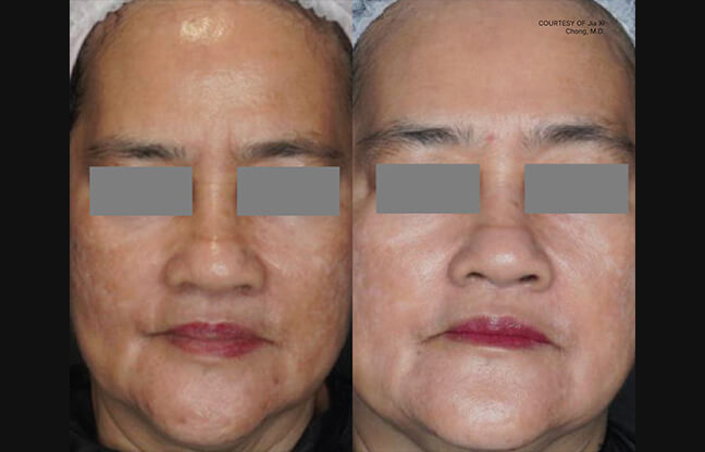 Fotona StarWalker® - Before & After 3 | EverYoung Skin Clinic