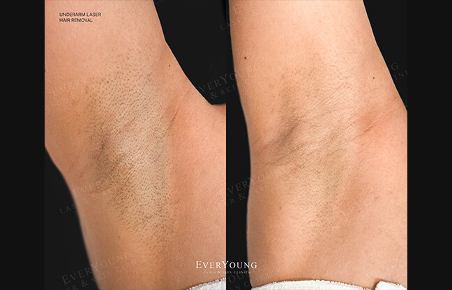 Laser Hair Removal - Before & After 1 | EverYoung Skin Clinic
