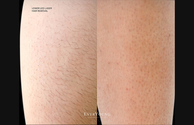 Laser Hair Removal - Before & After 2 | EverYoung Skin Clinic