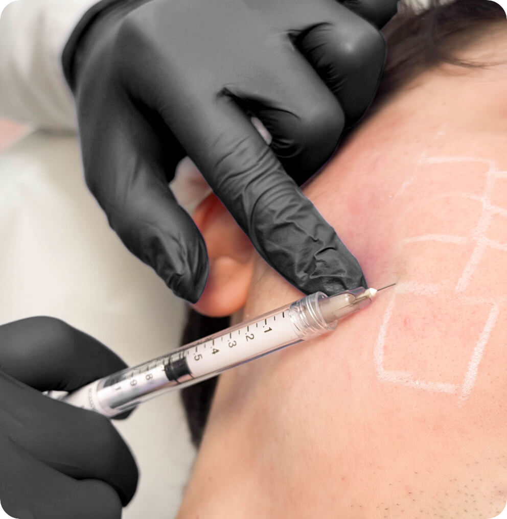 Radiesse Radiesse Vancouver | EverYoung Skin Clinic