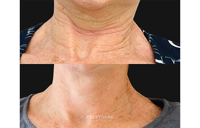 Secret™ RF Microneedling - Before & After 1 | EverYoung Skin Clinic Vancouver