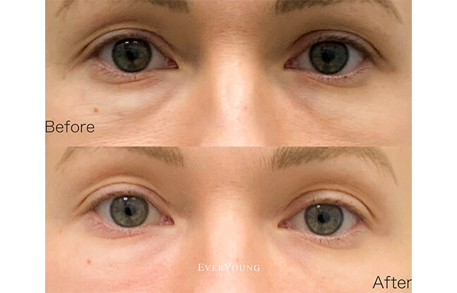 Secret™ RF Microneedling - Before & After 3 | EverYoung Skin Clinic Vancouver