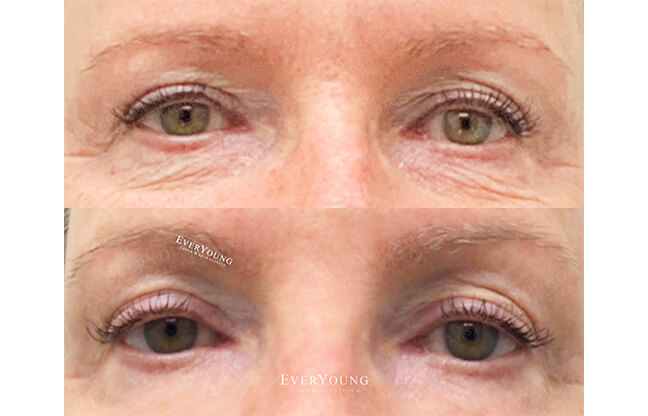 Secret™ RF Microneedling - Before & After 4 | EverYoung Skin Clinic Vancouver