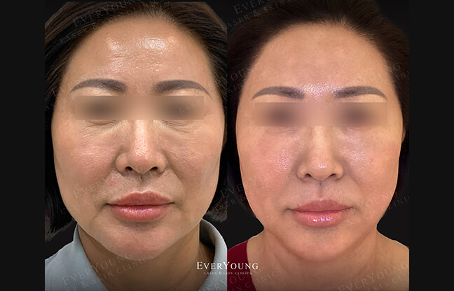 Sylfirm X Treatment - Before & After | EverYoung Laser Skin Clinic