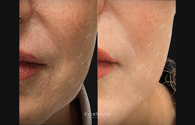 Thermage Skin Tightening - Before & After 1 | EverYoung Skin Clinic