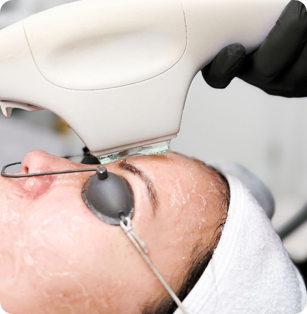 BBL Photo Facial Treatment in Vancouver | EverYoung Skin Clinic