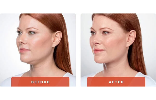 Belkyra™ Kybella Double Chin Treatment - Before & After 1 | EverYoung