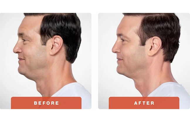 Belkyra™ Kybella Double Chin Treatment - Before & After 2 | EverYoung