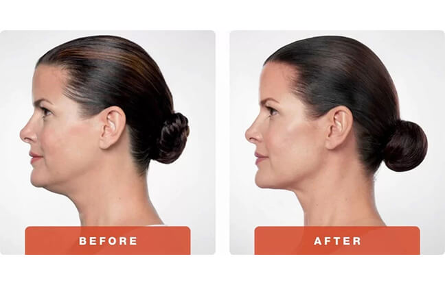 Belkyra™ Kybella Double Chin Treatment - Before & After 4 | EverYoung