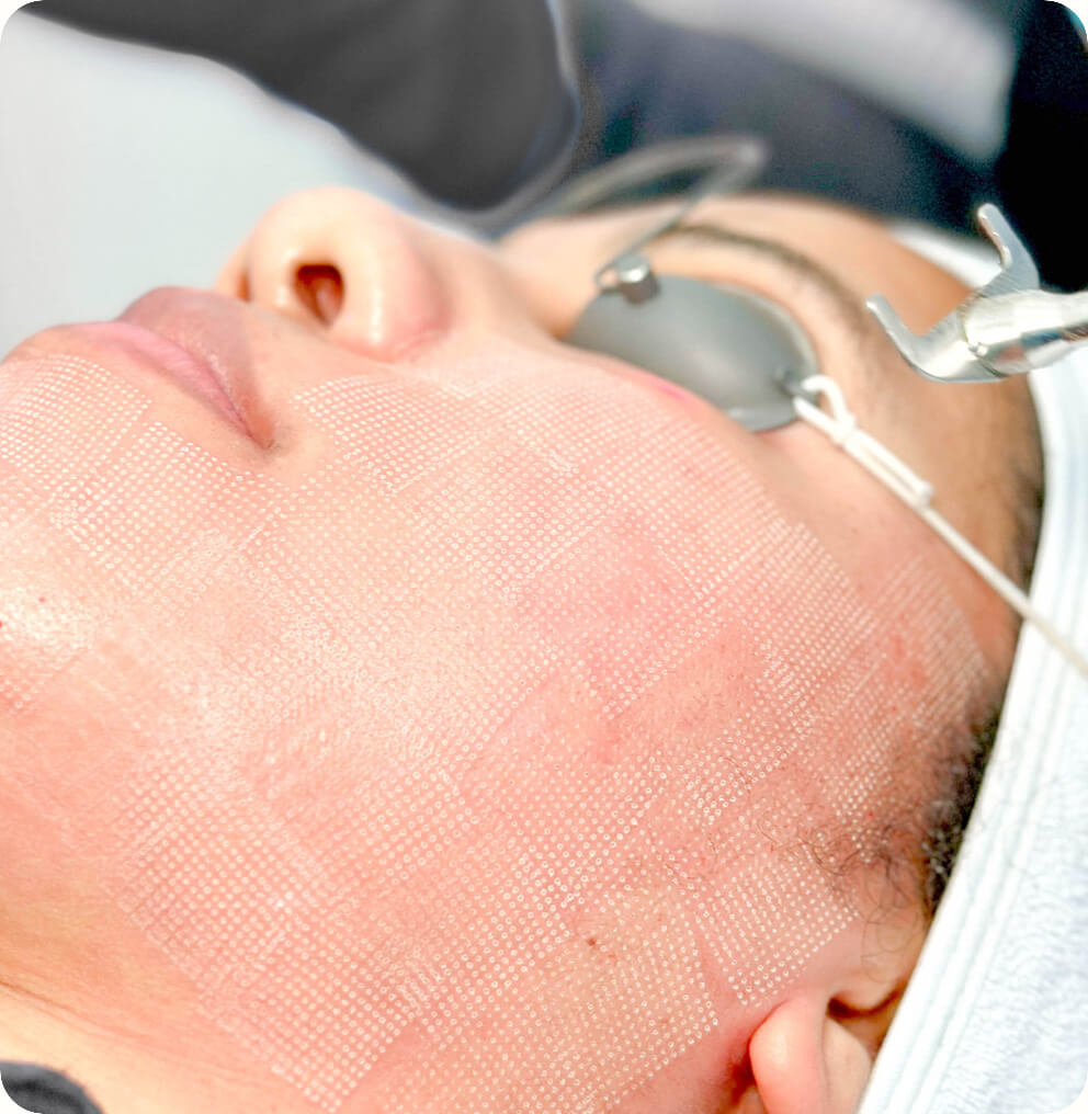 CO2 Resurfacing Vancouver | EverYoung Skin Clinic