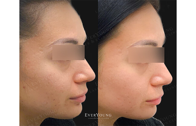 Fractional Skin Resurfacing - Before & After 2 | EverYoung Skin Clinic