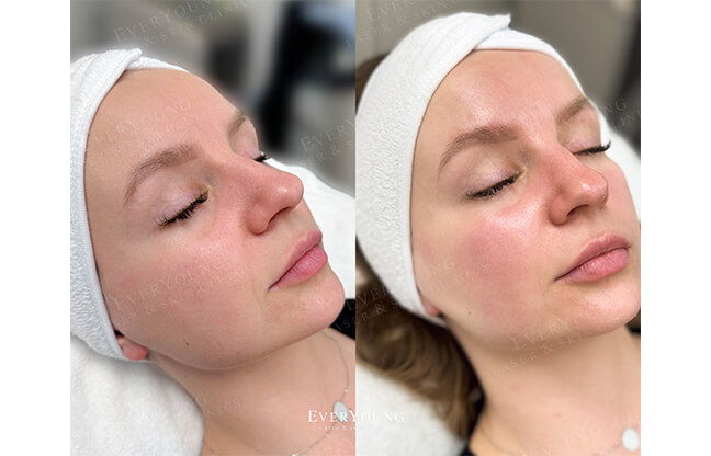 HydraFacial MD® Treatment - Before & After 1 | EverYoung Skin Clinic
