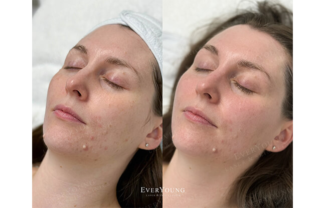 HydraFacial MD® Treatment - Before & After 2 | EverYoung Skin Clinic
