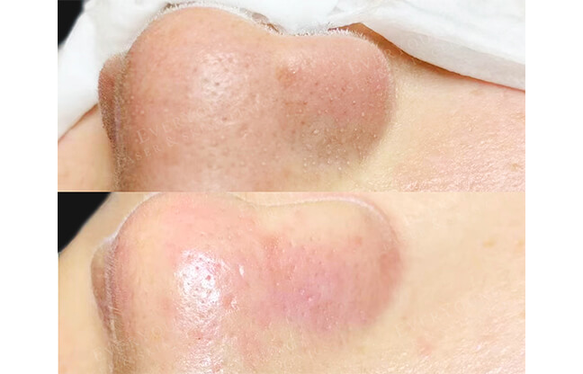 HydraFacial MD® Treatment - Before & After 4 | EverYoung Skin Clinic