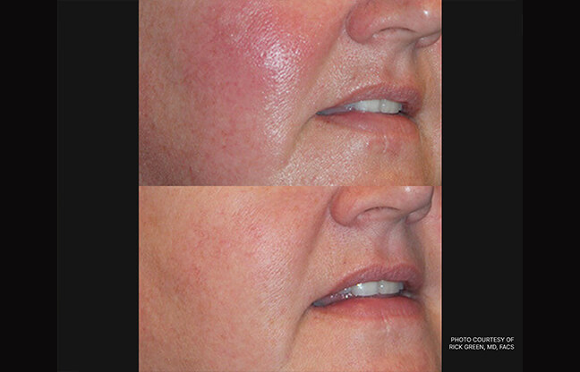 Laser Genesis Treatment - Before & After 1 | EverYoung Skin Clinic