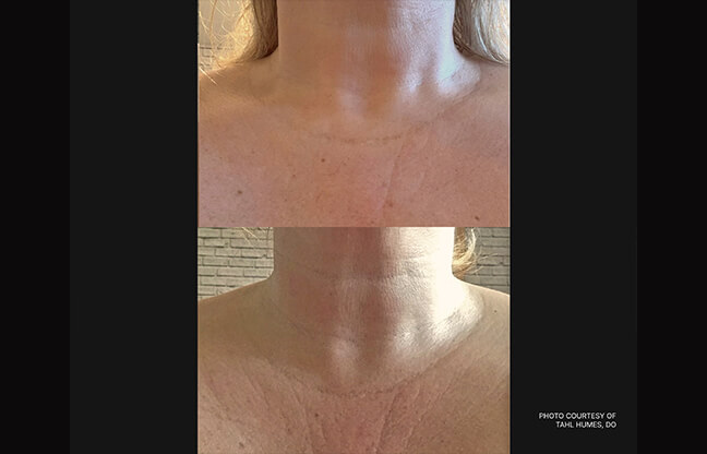 Laser Genesis Treatment - Before & After 2 | EverYoung Skin Clinic