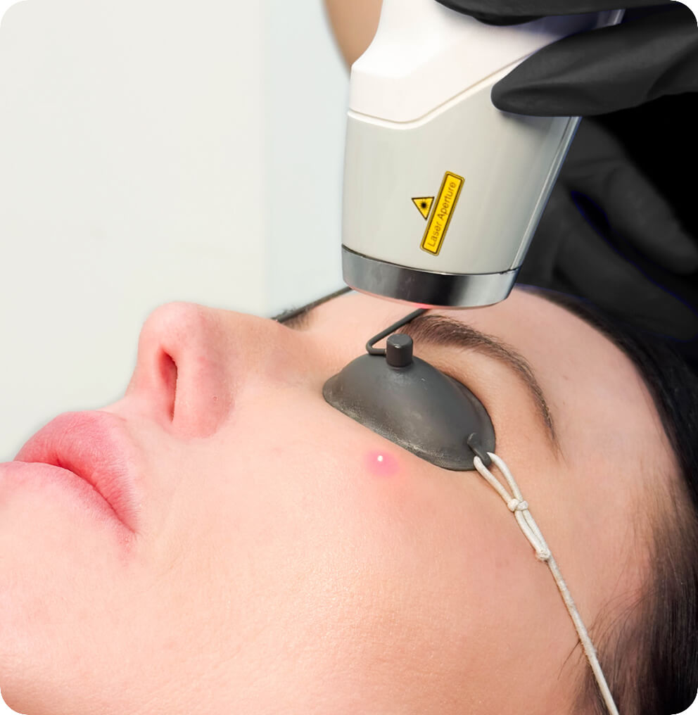 Laser Genesis Treatment Vancouver | EverYoung Skin Clinic