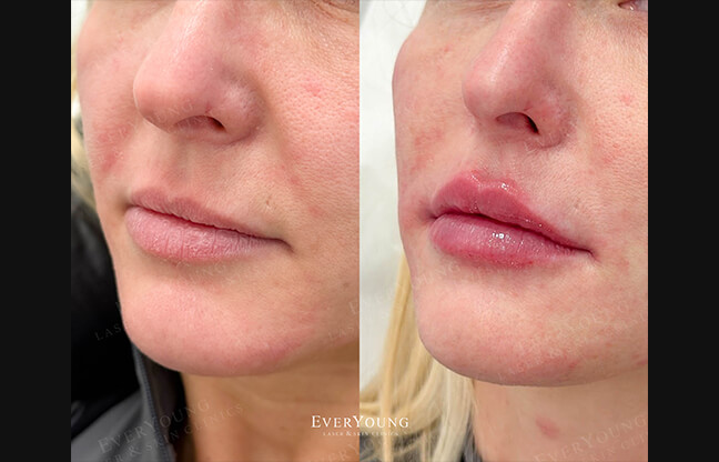 Lip Fillers in Vancouver - Before & After 1 | EverYoung Skin Clinic