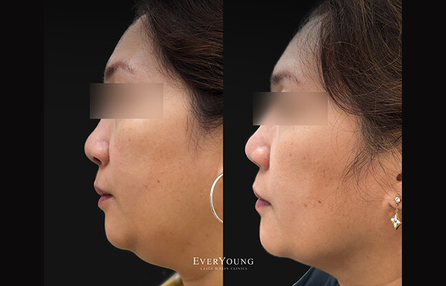 Lipodissolve Treatment - Before & After 1 | EverYoung Skin Clinic