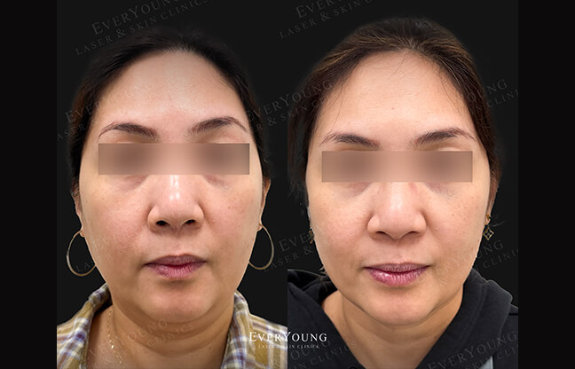 Lipodissolve Treatment - Before & After 2 | EverYoung Skin Clinic