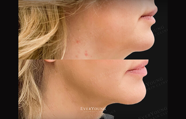 Lipodissolve Treatment - Before & After 3 | EverYoung Skin Clinic