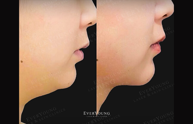 Lipodissolve Treatment - Before & After 4 | EverYoung Skin Clinic