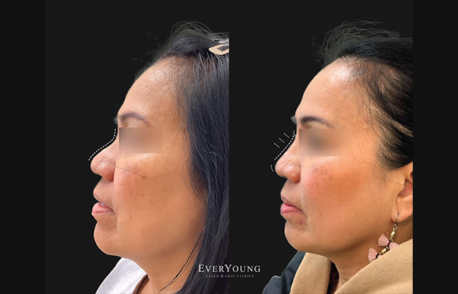 Non-Surgical Nose Job - Before & After 1 | EverYoung Skin Clinic