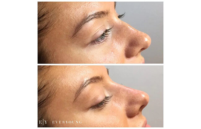 Non-Surgical Nose Job - Before & After 2 | EverYoung Skin Clinic