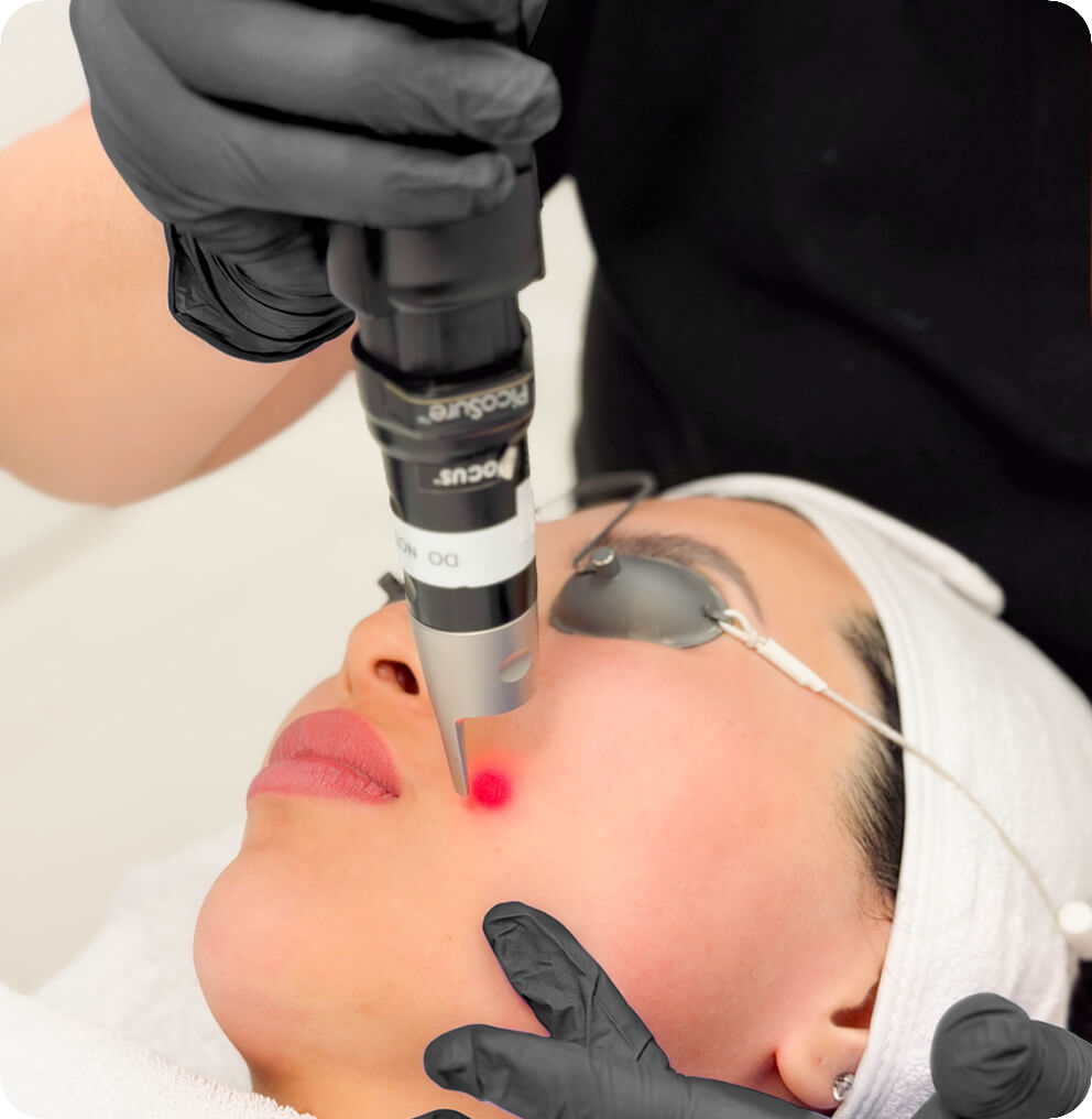 PicoSure Treatment in Vancouver | EverYoung Skin Clinic