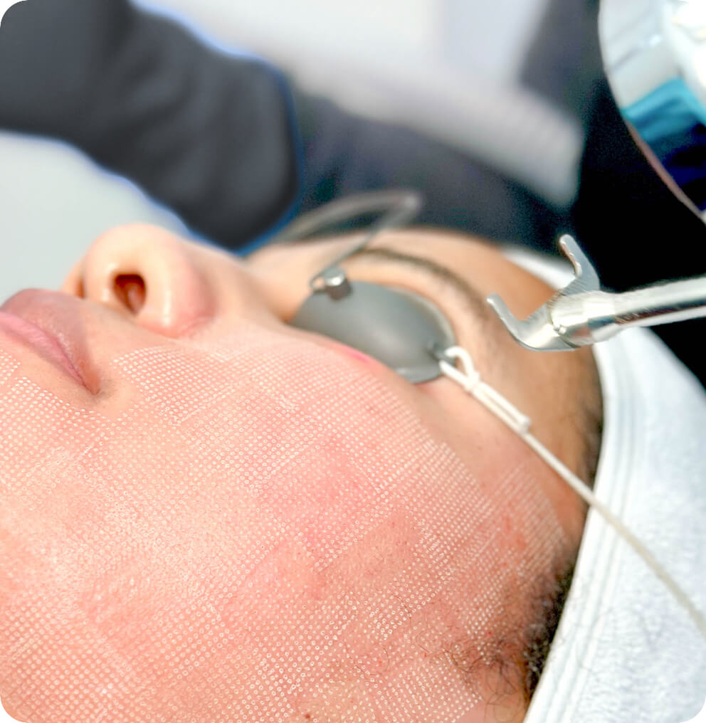 profractional-laser ProFractional Laser Vancouver | EverYoung Skin Clinic