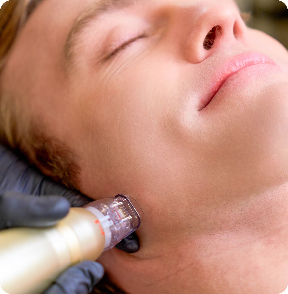 Sylfirm X Vancouver | EverYoung Skin Clinic