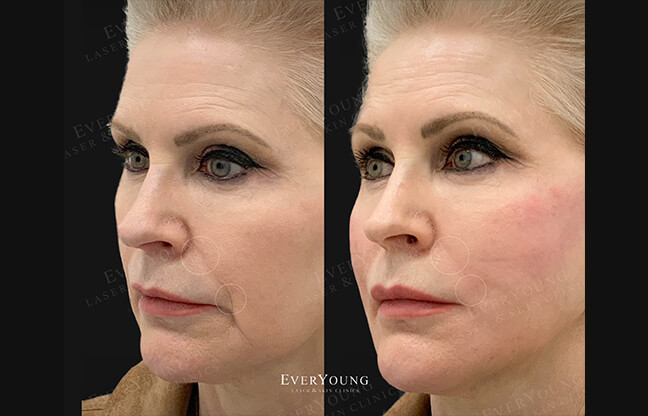 Silhouette Thread Lift - Before & After 1 | EverYoung Skin Clinic