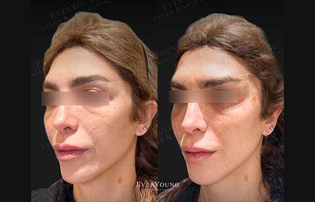 Silhouette Thread Lift - Before & After 2 | EverYoung Skin Clinic