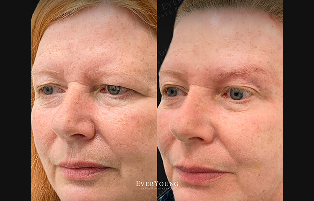 Silhouette Thread Lift - Before & After 3 | EverYoung Skin Clinic