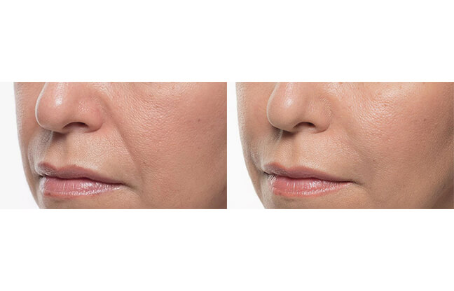 Bellafill® Acne Scar - Before & After 2 | EverYoung Skin Clinic