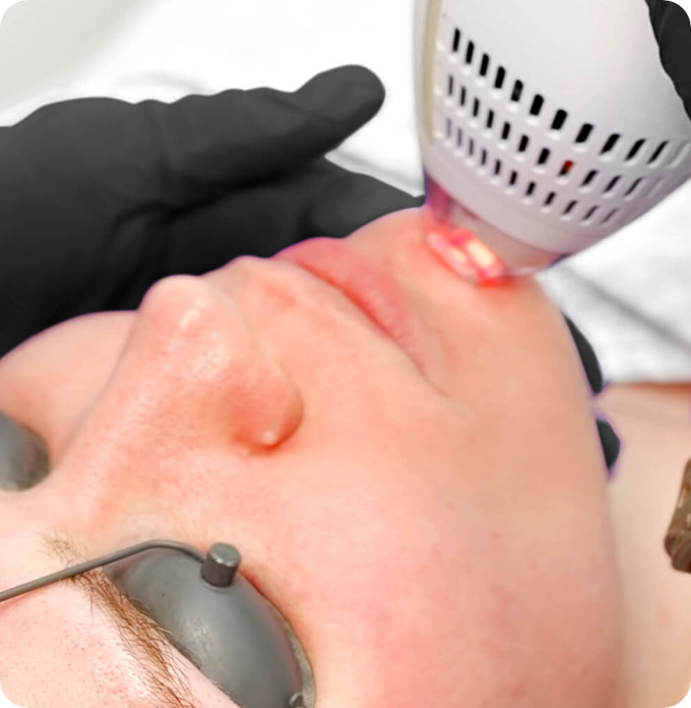 Clear + Brilliant Laser Skin Treatment in Vancouver | EverYoung
