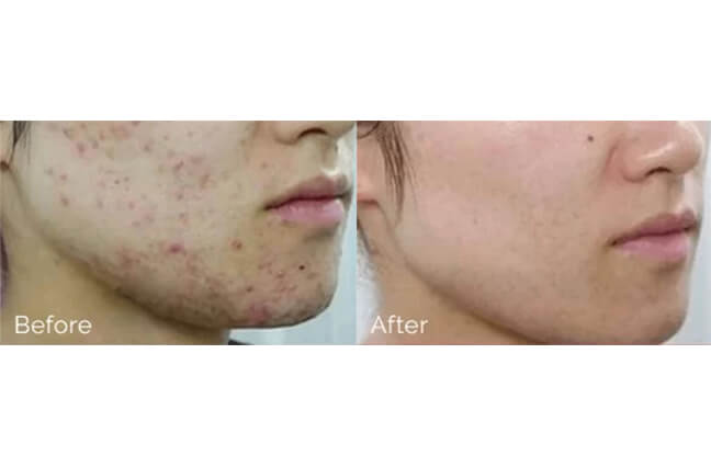 Emergency Cyst Removal - Before & After 1 | EverYoung Skin Clinic