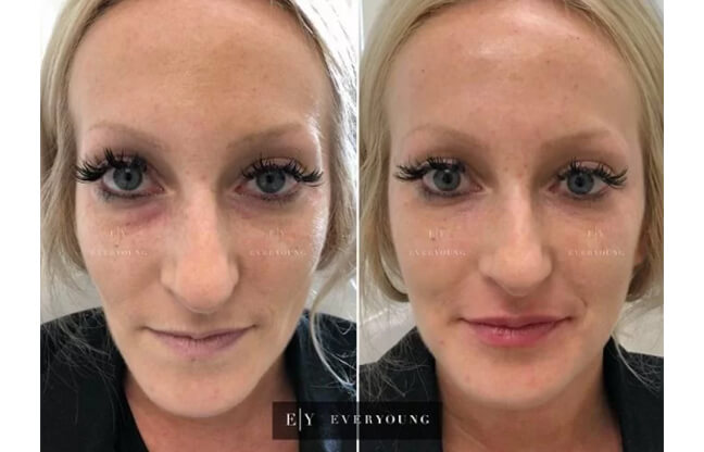 Face Sculpting and Contouring - Before & After 1 | EverYoung Skin Clinic Vancouver