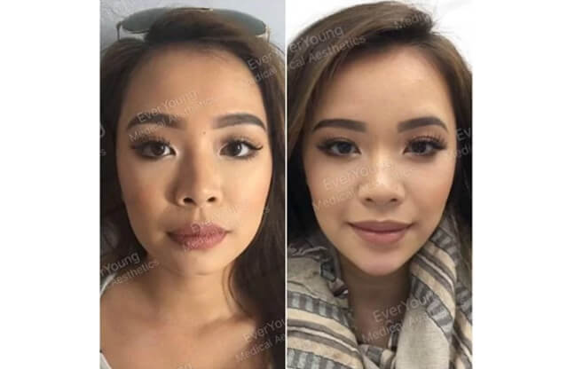Face Sculpting and Contouring - Before & After 2 | EverYoung Skin Clinic Vancouver